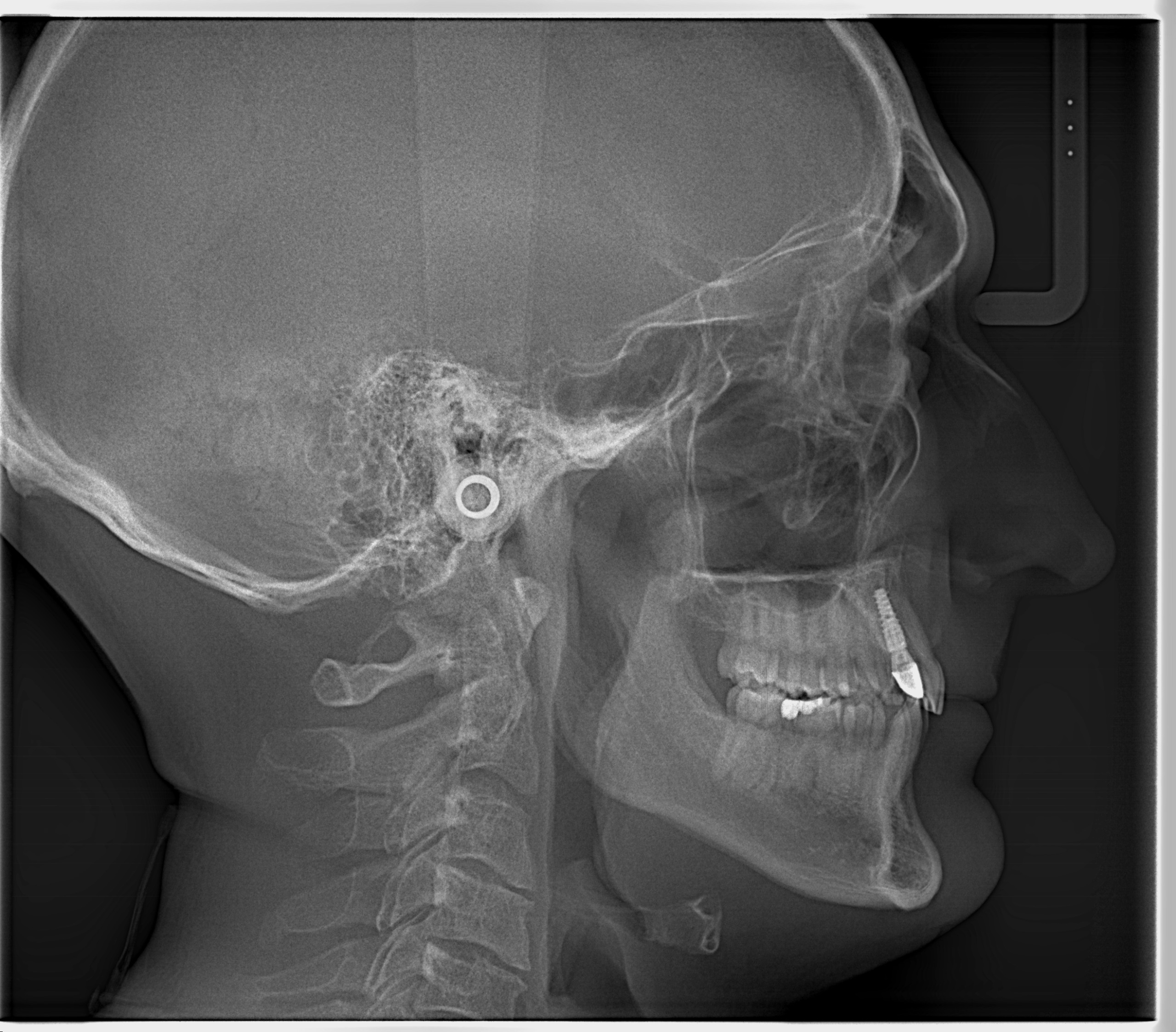 Telerradiografia lateral utilizada na documentação ortodôntica
