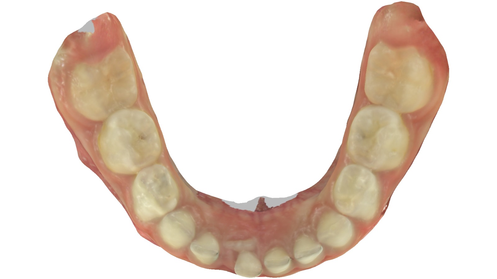 Escaneamento intraoral digital da arcada inferior