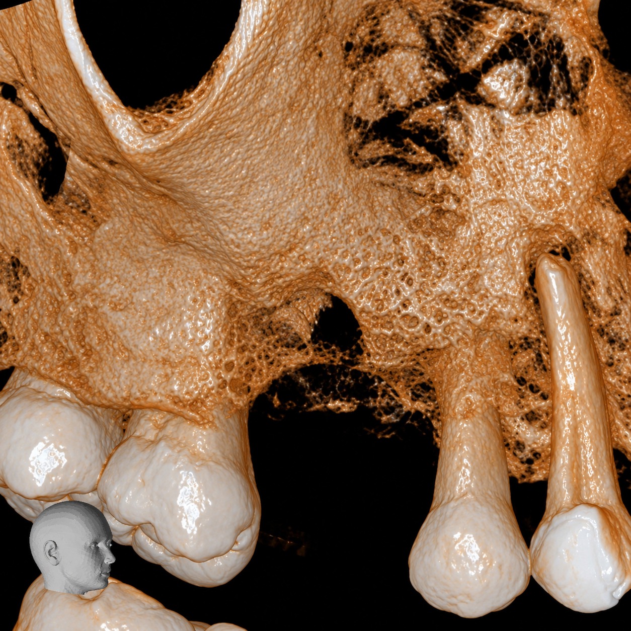 Modelo 3D impresso a partir de tomografia