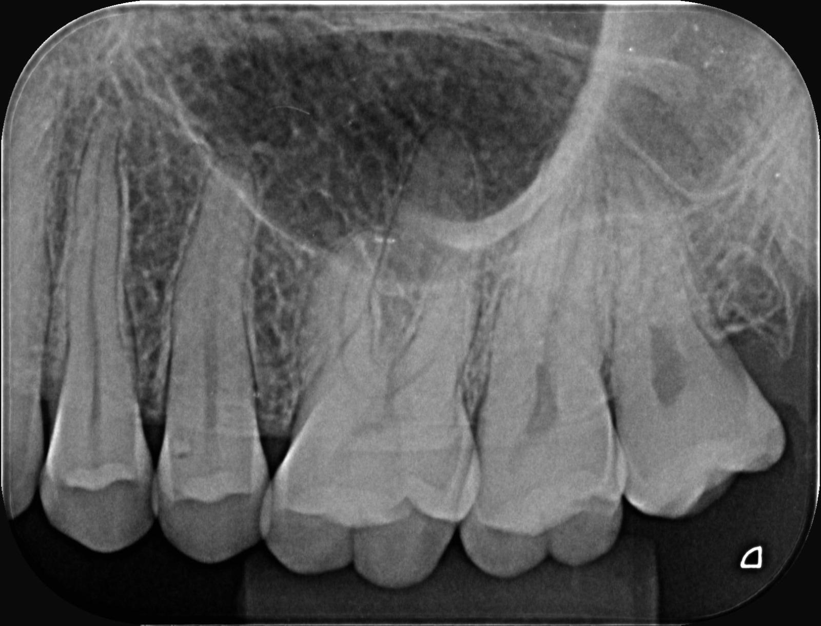 Radiografia periapical de raiz dentária