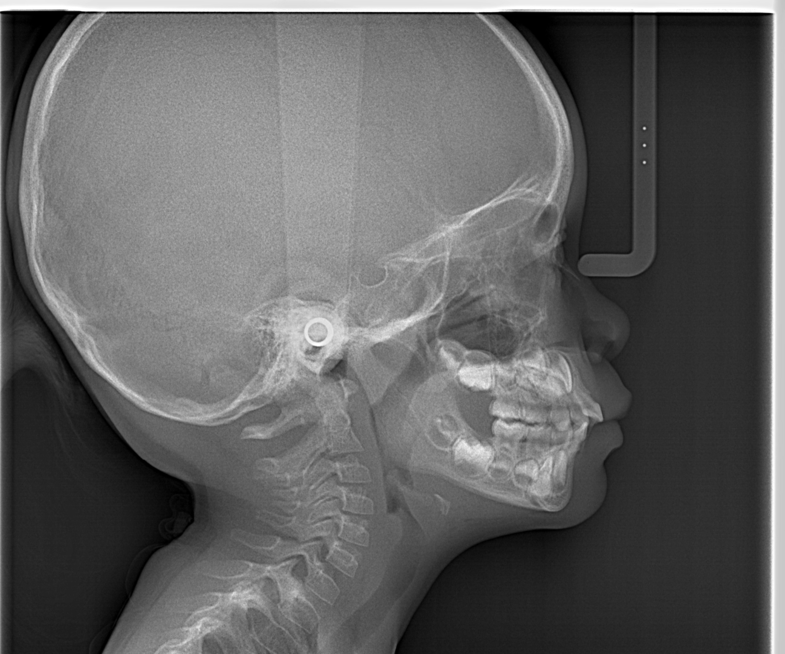 Telerradiografia para análise cefalométrica