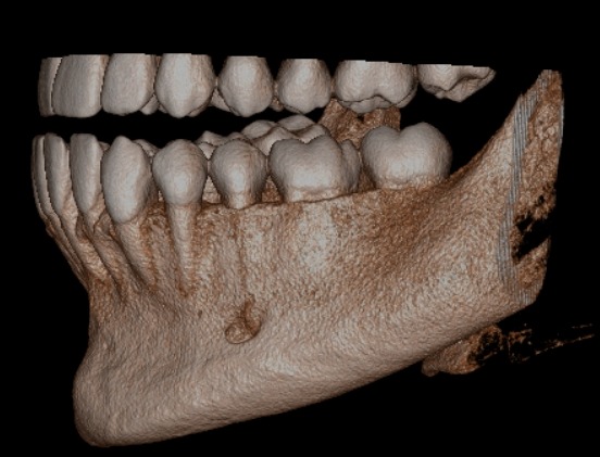 Reconstrução 3D de tomografia Cone Beam